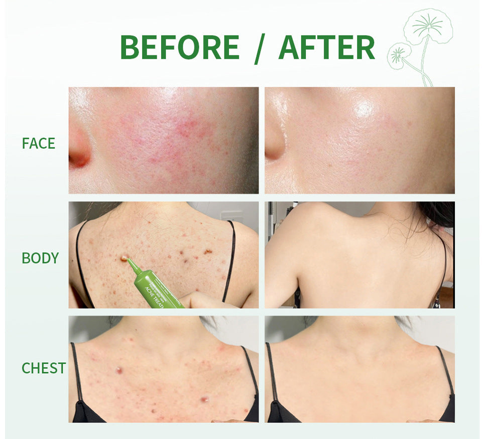 Acne Treatment Cream Facial Care THRU7