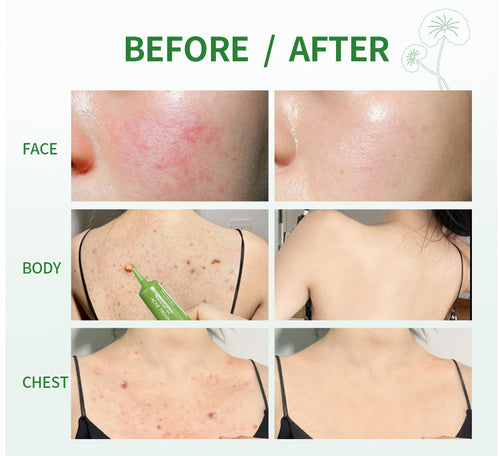 Acne Treatment Cream Facial Care THRU7